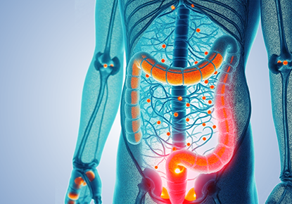 Ulcerative Colitis